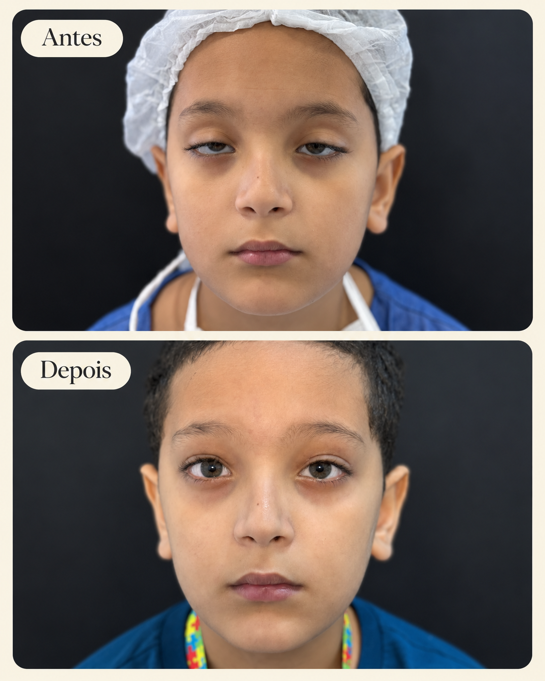 Antes e depois de cirurgia realizada pela Dra. Raianne Lima