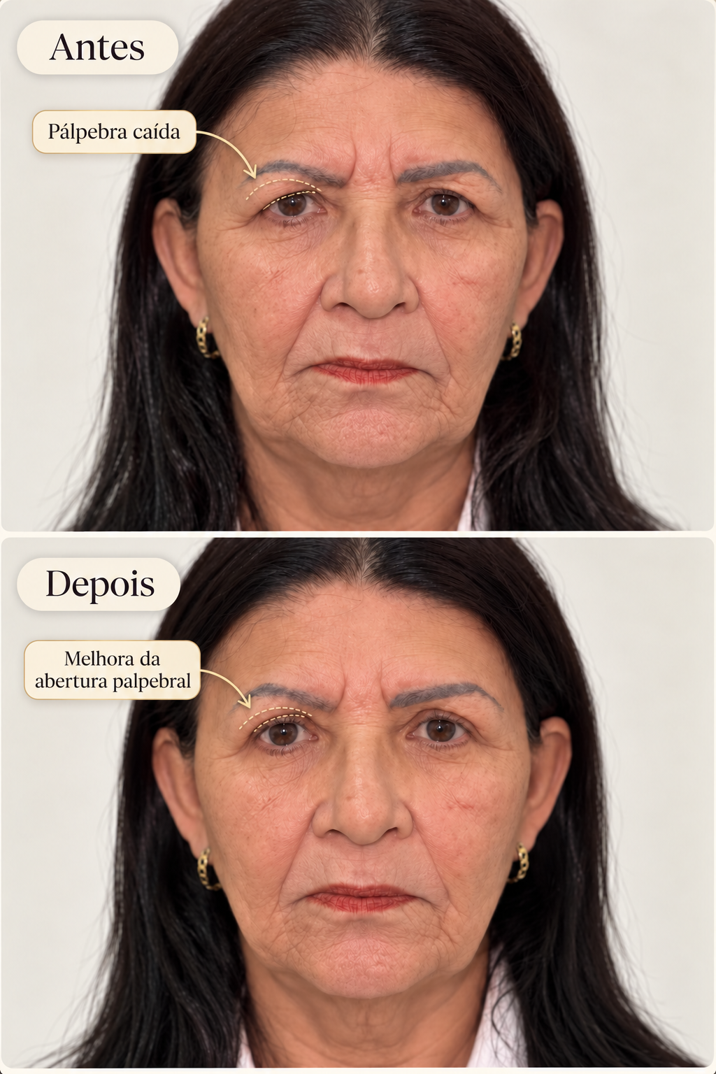 Antes e depois de procedimento realizado pela Dra. Raianne Lima